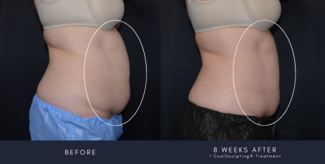 How To Maximize Outcomes After Coolsculpting?